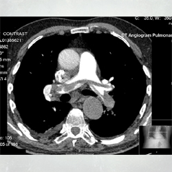 Computed tomography pulmonary angiography