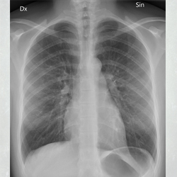 Chest X-ray Chest X-ray