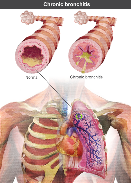 Lungs showing bronchitis mucus